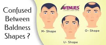 Confused Between U Shaped M Shaped O Shaped U Shape Alopecia Treatment Overprocessed Hair