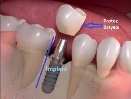 2021 yılı ağız diş sağlığı muayenesi tedavi ücret tarifesi, fiyatları tablo halinde eklenmiştir. Implant Fiyatlari Dent Ankara 2020 Guncel Ucretler