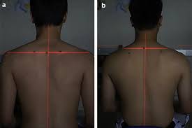 An upper (descending) part which supports the weight of the arm; Study Of The Trapezius Muscle Region Pressure Pain Threshold And Latency Time In Young People With And Without Depressed Scapula Manual Therapy