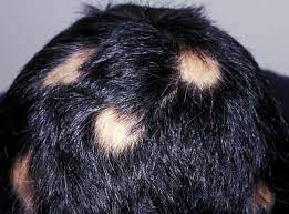 Can scalp psoriasis cause permanent hair loss? Thinning Hair And Itchy Scalp