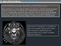 El dolor muscular se localiza en la zona del cuello pero puede subir a la cabeza o bajar al hombro o espalda. Diagnstico Por Rm De La Tortcolis En Pediatra