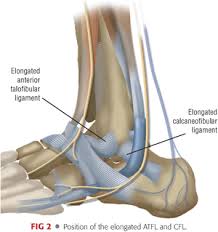 It is part of the lateral collateral ligament, which opposes the hyperinversion of the subtalar joint, as in a common type of ankle sprain. Anatomic Repair Of Lateral Ankle Instability Musculoskeletal Key