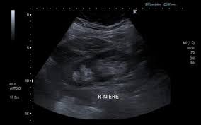 Duplex Collecting System Radiology Case Radiopaedia Org