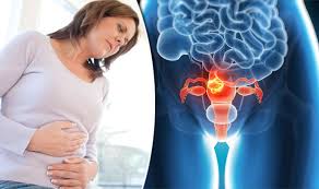 Even if the cancer is advanced and a cure is not possible, radiotherapy may still have a place to ease symptoms. Womb Cancer Symptoms Signs You Could Have Cancer Of The Uterus Express Co Uk