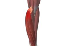 Golfer's elbow, or medial epicondylitis, is a common overuse injury of the inside portion of the elbow. Golfers Elbow Treatment Milwaukee Medial Epicondylitis Waukesha Mequon Wi