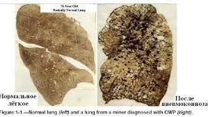 Pneumokoniose Wikipedia