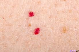 Cherry angioma is composed of several capillaries or smallest blood vessels of the body. Cherry Angioma Symptoms Causes Severity Treatment Factdr