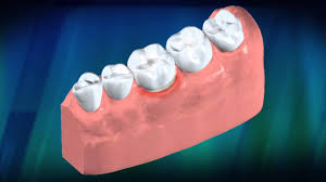 There are several factors that cause sudden cavities. Sensitive Teeth Heat And Cold Sensitivity American Dental Association