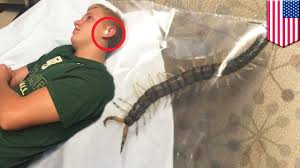 Un Mille Pattes Est Retire De L Oreille D Un Adolescent Youtube