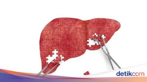 Penyebab dari penyakit liver bisa berasal dari infeksi oleh satu hal yang harus diperhatikan, bahwa tidak semua penyakit liver akan menyebabkan gejala kuning pada kulit dan bagian perbedaan liver dan hepatitis. Lokasinya Sama Ini Bedanya Hepatitis Dan Kanker Hati