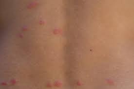 Nous connaissons tous la peste, transmise à l'homme par simple piqûre de puce. Piqure De Puce Symptomes Photo La Reconnaitre Que Faire