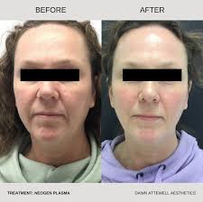 Therapy House Results 👏🏻 Transform Your Skin with NeoGen Plasma! ✨  Discover the ultimate in skin rejuvenation as NeoGen Plasma works beneath  the surface to unveil a complexion that's smoother, firmer, and