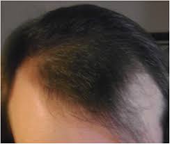 Hair follicles cycle between rest and growth. Scalp Hair Regrowth In Hormone Treated Transgender Woman Transgender Health