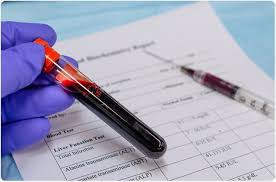 Image result for Liver Function Test Abnormality