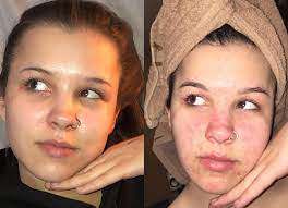 Vitamin e supplement for acne reddit. This Woman Used Three Products From The Same Beauty Line To Cure Her Acne You Magazine
