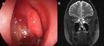 Image result for Drug-Induced Olfactory Dysfunction