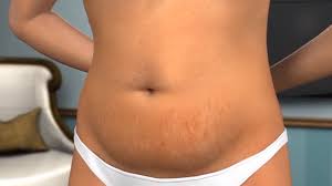 Sep 26, 2020 · a tummy tuck surgery is an elective cosmetic surgery that you might consider if you want to have a flatter, firmer appearing stomach. How Much Is A Tummy Tuck In Mexico In 2021