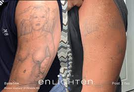 For this reason you are not able to get laser hair removal over a tattoo. 13 Tips When You Re Preparing For Laser Tattoo Removal
