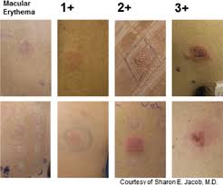 Image result for Patch Testing