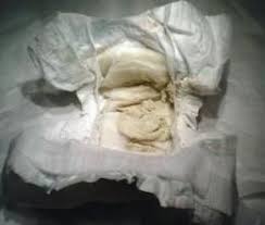 Image result for acholic stools human