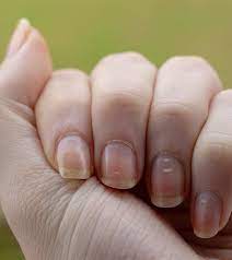 White Spots On Nails: What Are They And How To Treat Them?