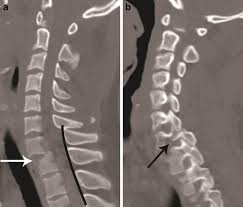 Это apex vertebra, spinolaminar line, interpediculate distance, apex of odontoid process, segmental spinolaminar junction line. Mdct Of Acute Subaxial Cervical Spine Trauma A Mechanism Based Approach Insights Into Imaging Full Text