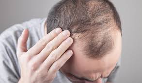 This type of hair loss is called traction alopecia. How Prp Can Help Reverse Thinning Hair Warrenton Dermatology Skin Therapy Center Board Certified Dermatologists