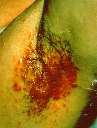 Intertrigo, or intertriginous dermatitis, is a common inflammatory condition of skin folds characterized by moist erythema, malodor, weeping, pruritus intertrigo. Intertrigo Wikipedia