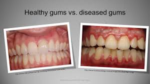 According to recent studies, almost 90% of dogs will have developed some form of periodontal disease by 2 years of age 1. Periodontal Gum Disease Ppt Download