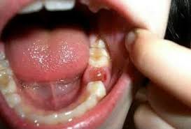 Terkadang, kita pasti pernah mengalami bengkak pada gusi. Sakit Gigi Dan Bengkak Di Dalam Gusi Steemit