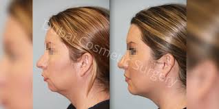 عملية تجميل الذقن في ايران من اجل تكبير أو تصغير أو تقديم أو إرجاع الذقن بأخفض تكلفة وافضل نتائج. Ø¹Ù…Ù„ÙŠØ© Ø²Ø±Ø§Ø¹Ø© Ø§Ù„Ø°Ù‚Ù† ÙÙŠ Ø¯Ø¨ÙŠ ØªÙƒØ¨ÙŠØ± Ø§Ù„Ø°Ù‚Ù† Ø¯Ø¨ÙŠ ÙƒÙˆØ³Ù…ØªÙƒ Ø³ÙŠØ±Ø¬Ø±ÙŠ