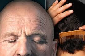 (eds.) hair and hair diseases. Hair Loss Treatment Try Acupuncture To Stimulate Hair Growth Express Co Uk