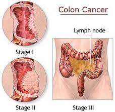 But bleeding is often the first sign of the disease. Colon Cancer Treatment In Chennai Symptoms And Treatment Of Rectum Cancer