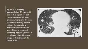 Histopathological diagnosis was well differentiation adenocarcinoma. Metastasis Pulmonal Atipikal Spektrum Temuan Radiologi Ppt Download