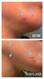 La roche posay effaclar cruelty free. Review La Roche Posay Effaclar Duo Acne Spot Treatment Before And After Dewildesalhabæ­¦å£«