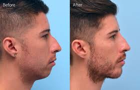 How to achieve the ultimate jawline? Jawline Sculpting With Fillers Candidates Results Cost Alternatives