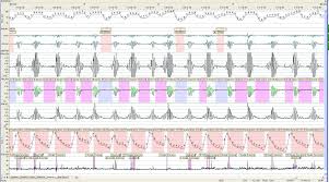 Sleep Apnea Living Well With Cmt Charcot Marie Tooth