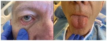 Image result for Multisystem Inflammatory Syndrome