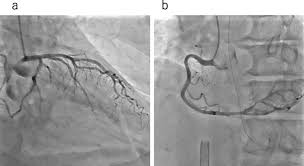 Frontiers | Renaissance Of Cardiac Imaging To Assist Percutaneous  Interventions In Congenital Heart Diseases:The Role Of Three-Dimensional  Echocardiography And Multimodality Imaging