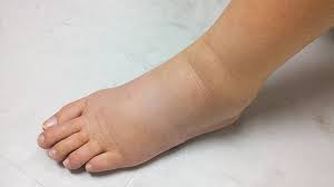 Peningkatan ukuran kaki dari pergelangan, perubahan warna kulit dan tekstur, sampai kulit hangat. Punca Kaki Bengkak Faktor Nombor 3 Memang Menyeramkan