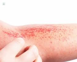 Image result for dermatitis contacta allergica