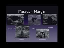 Combined screening with ultrasound and mammography vs mammography alone in women at elevated risk of breast cancer. Ultrasound Imaging Of The Breast Lesion Characterization Youtube