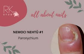 Image result for Akutní zánět nehtového lůžka