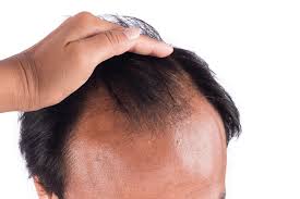 Choosing the right flaxseed oil can make or break a natural hair. Flaxseed Oil For Hair Loss Proven 3 Month Results Hair Growth