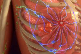Breast cancer cure by bone marrow transplant procedure:it's a method of giving very high amounts of chemotherapy,occasionally with entire body the bone marrow found in the body's spine and parts like breastbone, hips, skull and ribs have stem cells. Breast Cancer Recruits Cells From Bone Marrow To Boost Growth