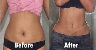 Image Result For Oberschenkellipo Before And After After Before Image Oberschenkellipo Result Lipo Before And After Vaser Lipo Liposuction