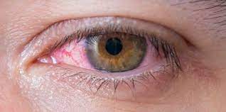 Ader Im Auge Geplatzt