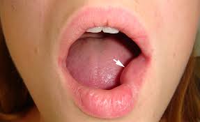 Image result for Labial mucosa
