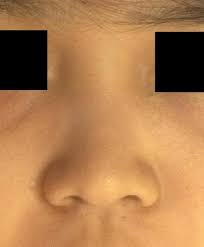 Asian Nose Bridge Too Low Fixing Without Implants Photo