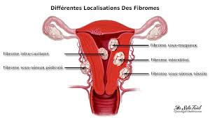 Fibrome Utérin